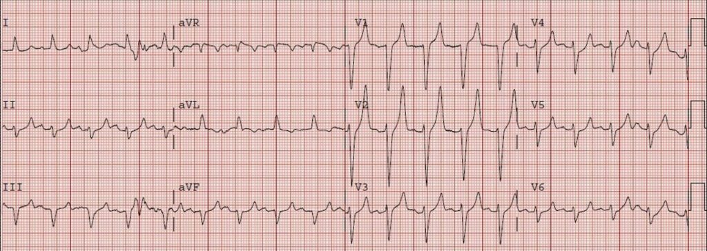 There are several EKG changes that you should be on the lookout for with hyperkalemia. You will see tall T waves (usually seen when K+ 5.0 - 6.0 mmol/l)