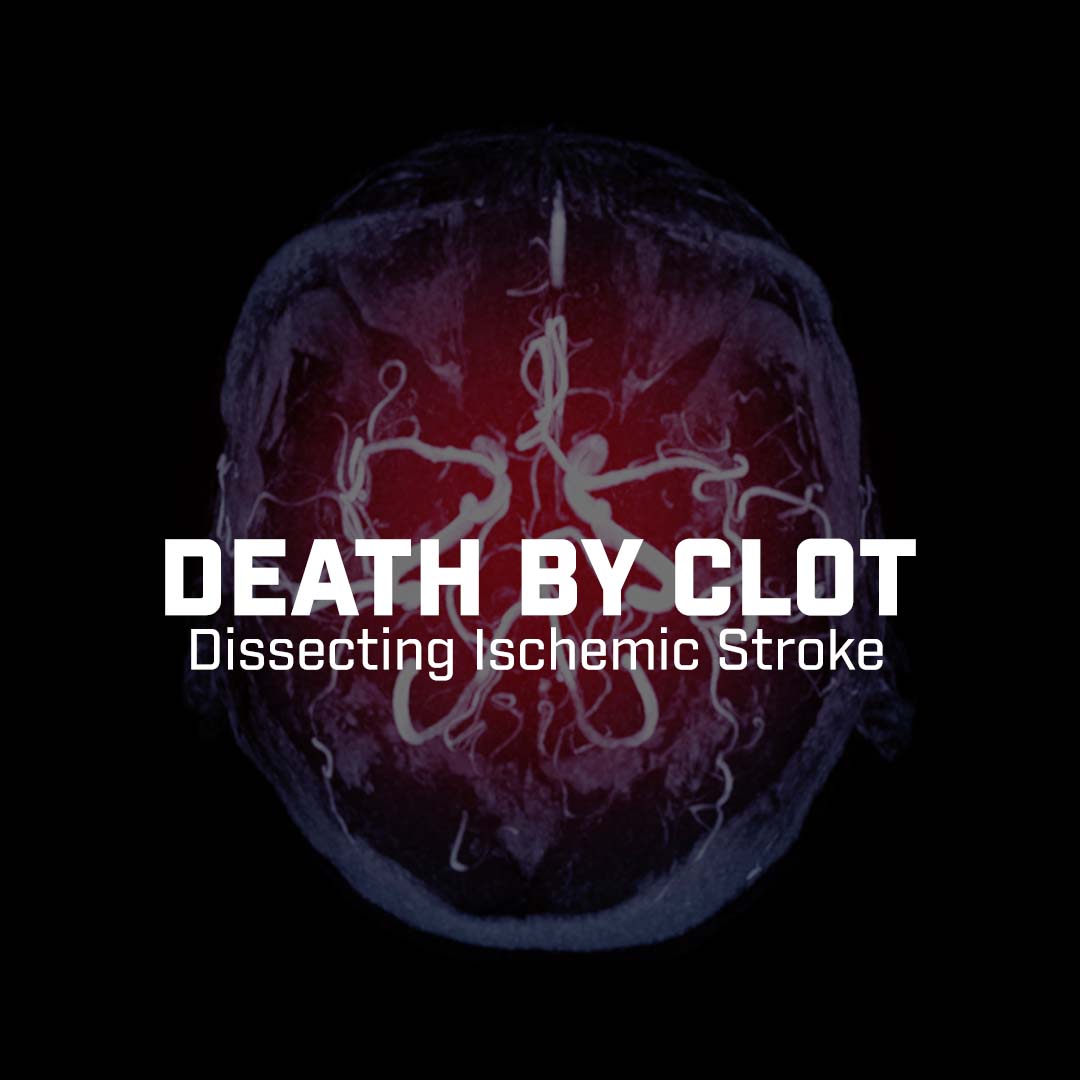 Death By Clot: Dissecting Ischemic Stroke