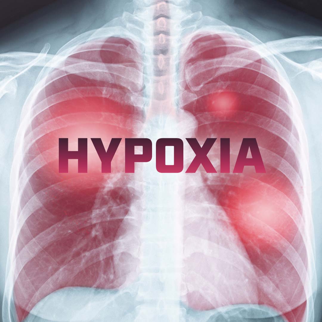 Hypoxia – FlightBridgeED